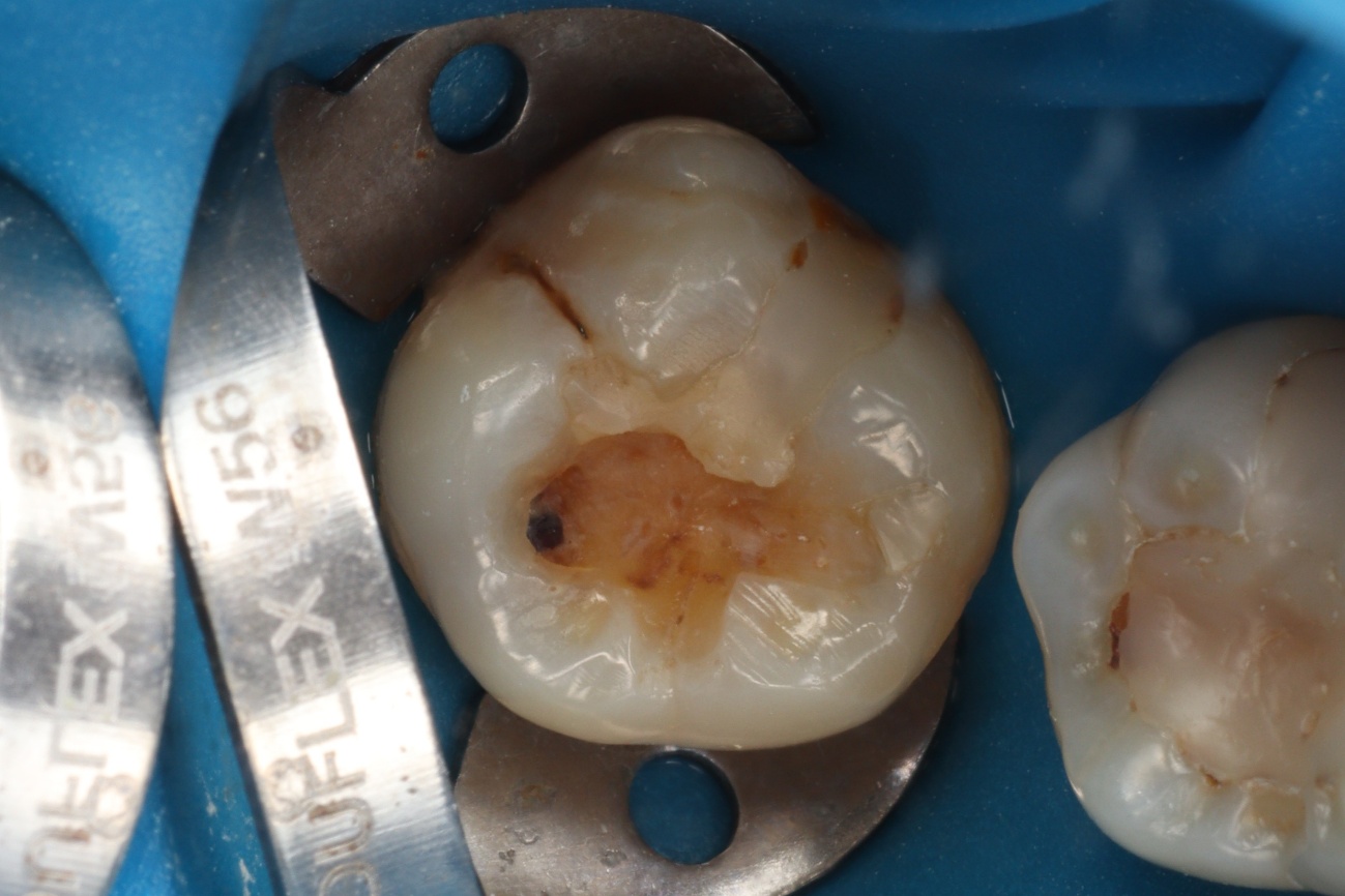 Figura 2 - Isolamento absoluto