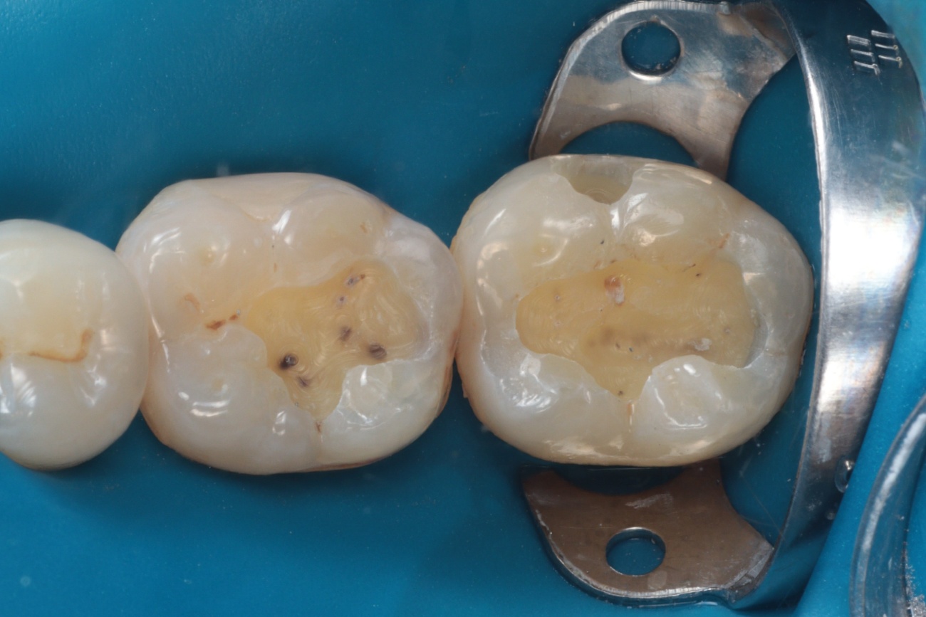 Figura 3 - Remoção do amálgama