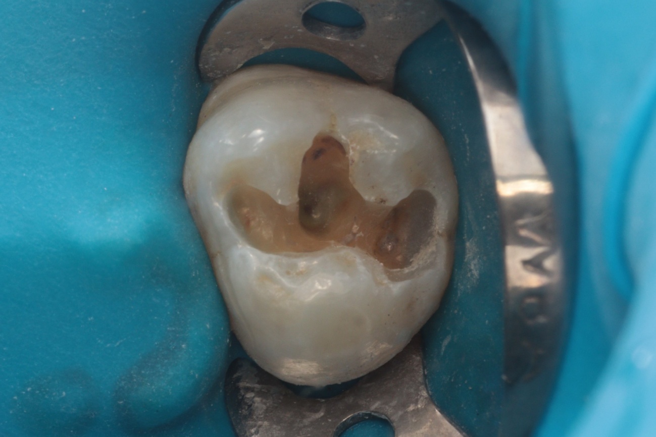 Figura 3 - Remoção do amálgama