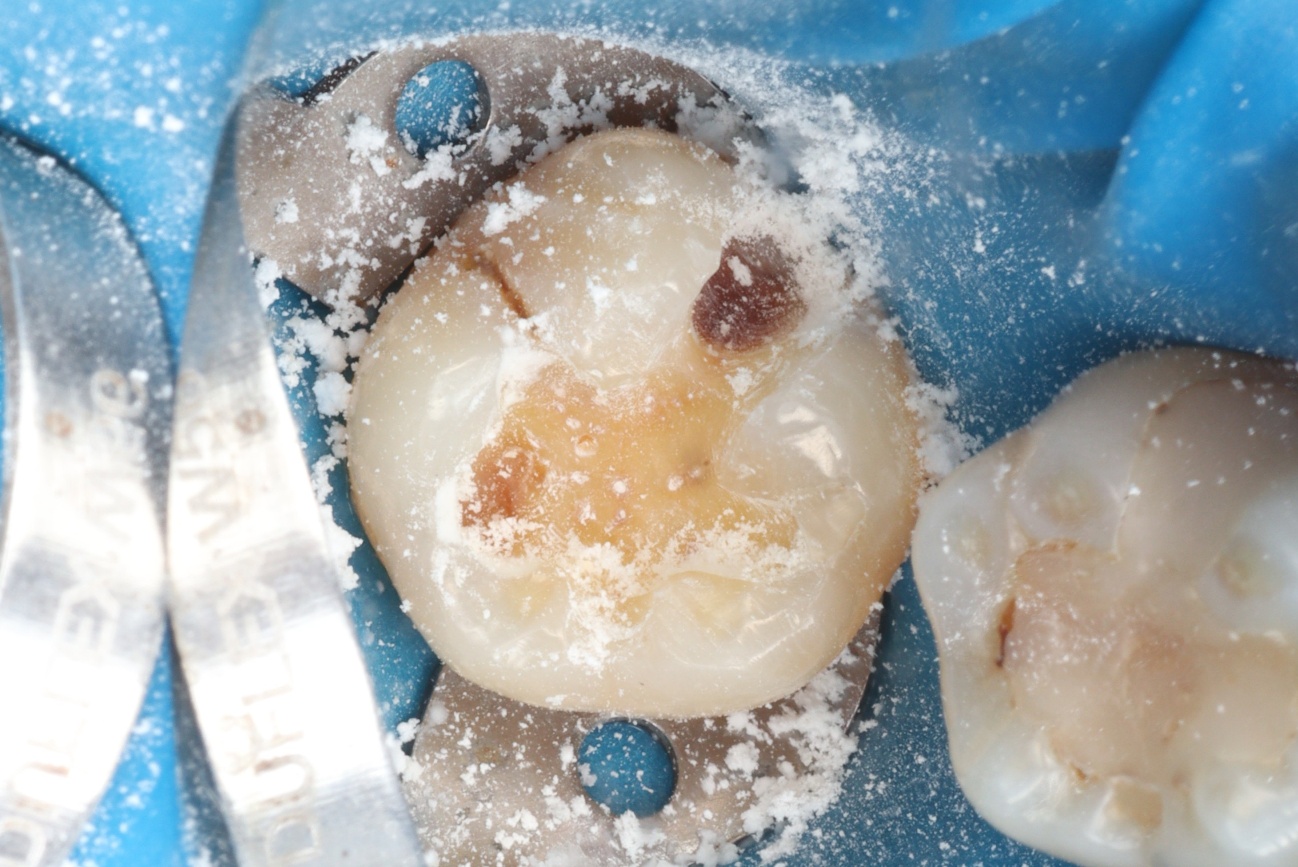 Figura 4 – limpeza cavitaria