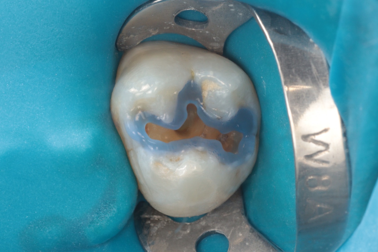 Figura 4 - Condicionamento Ácido