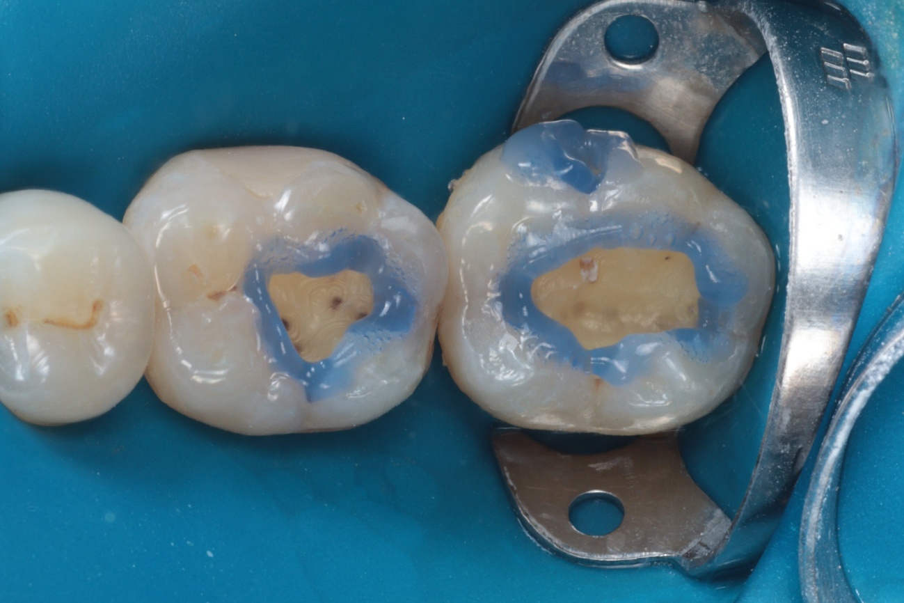 Figura 4 - Condicionamento ácido