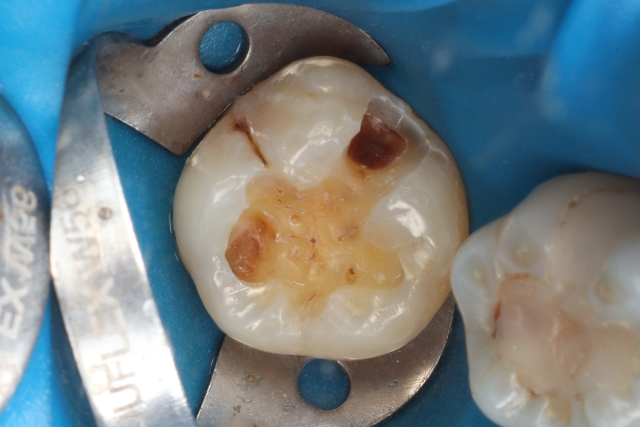 Figura 5 – cavidade limpa