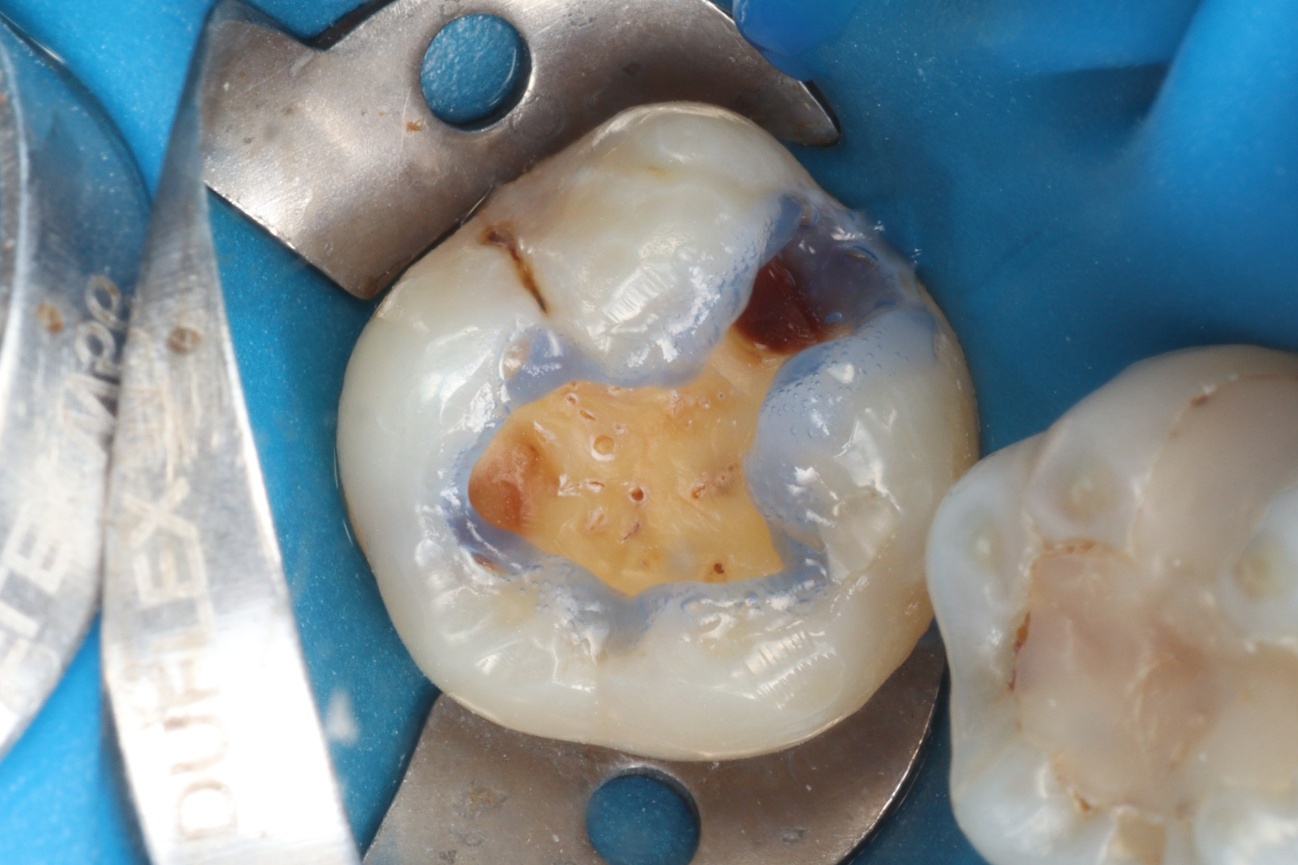 Figura 6 – ataque ácido