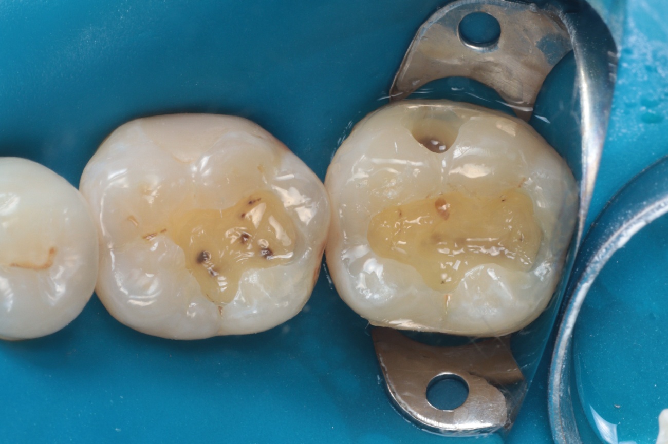 Figura 6 - Sistema adesivo