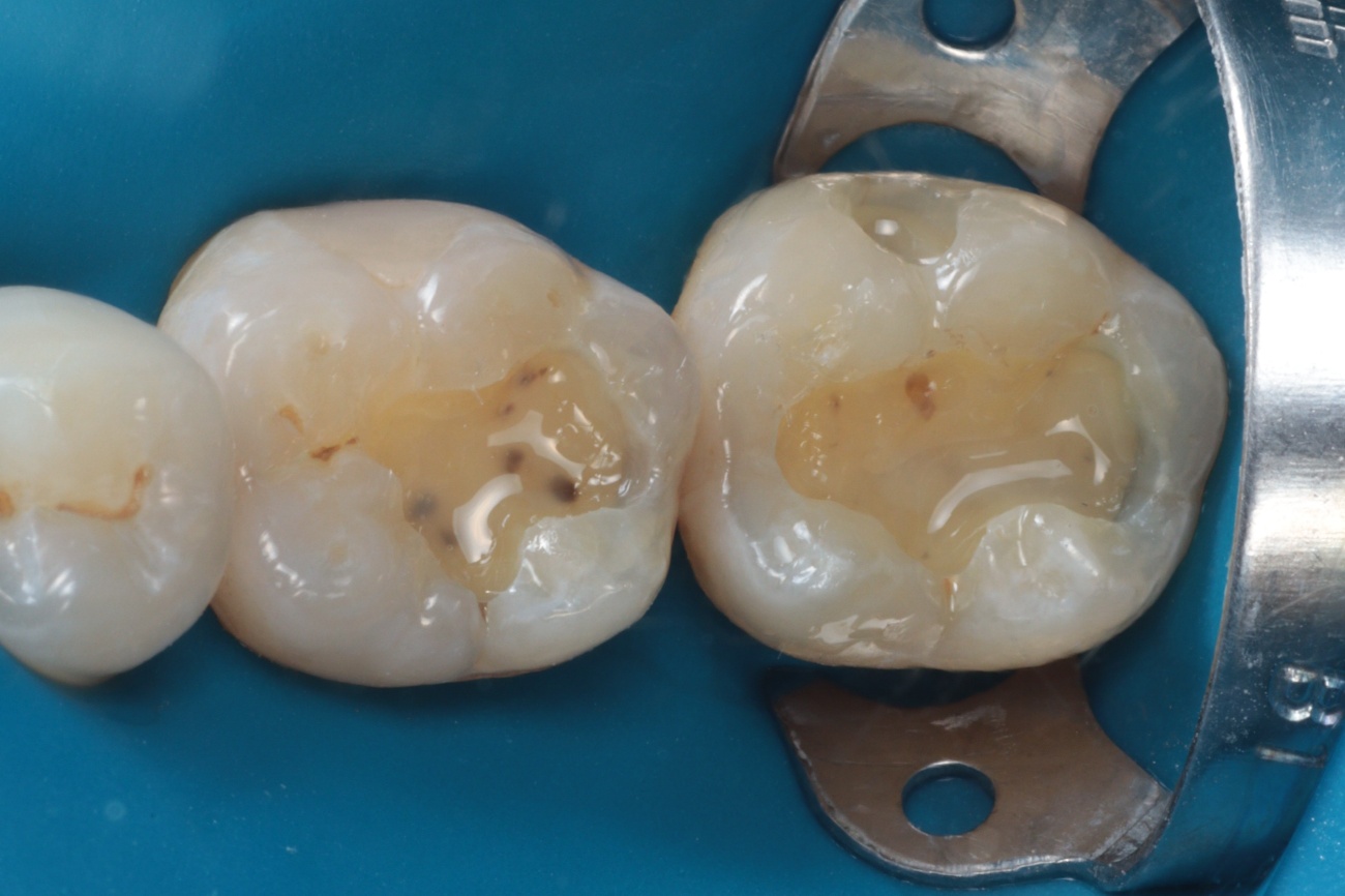 Figura 7 – liner com resina flow