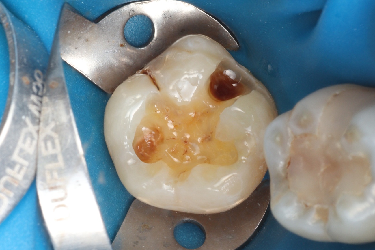 Figura 8 – sistema adesivo