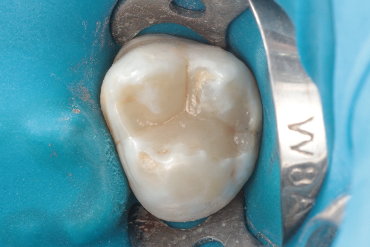 Figura 8 – acabamento e polimento