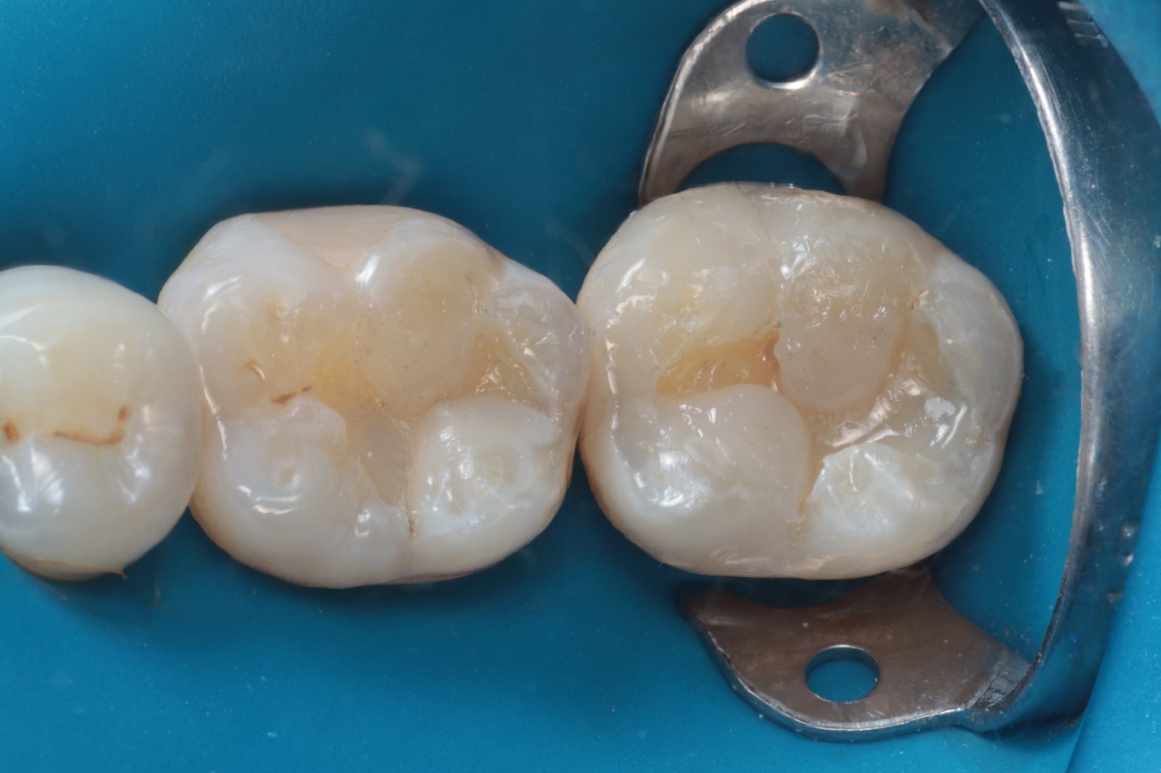Figura 8 – morfologia oclusal