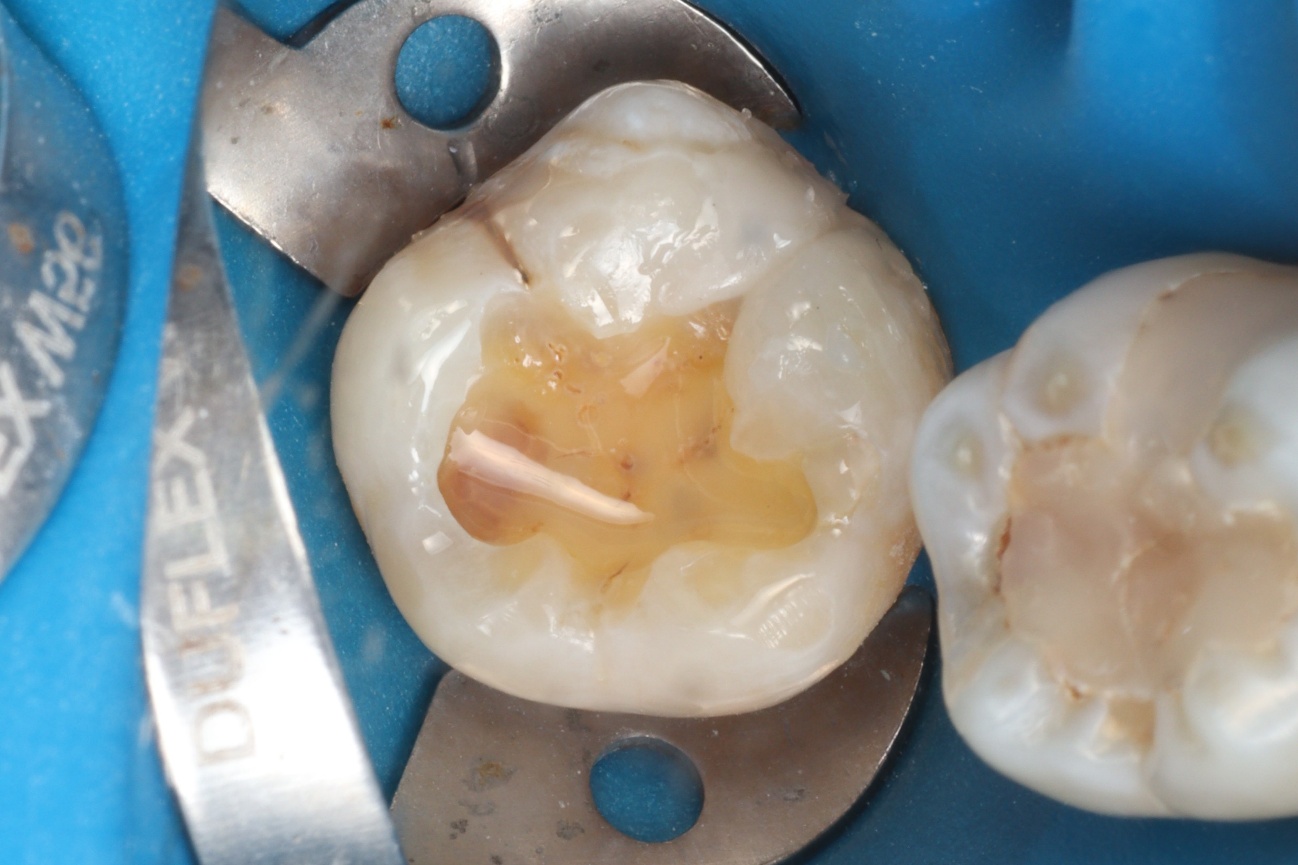 Figura 10 – parede vestibular