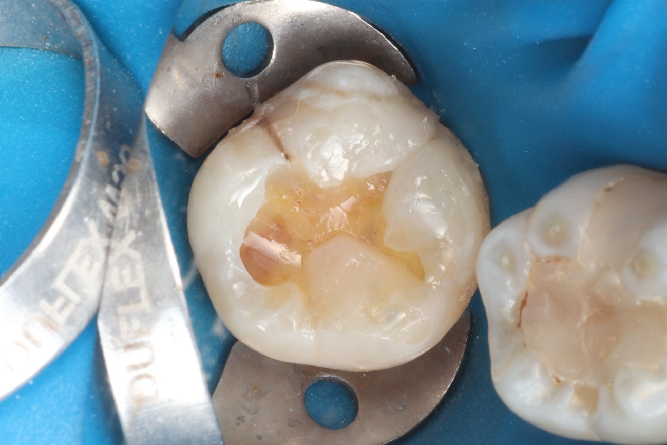 Figura 11 –cúspide ML