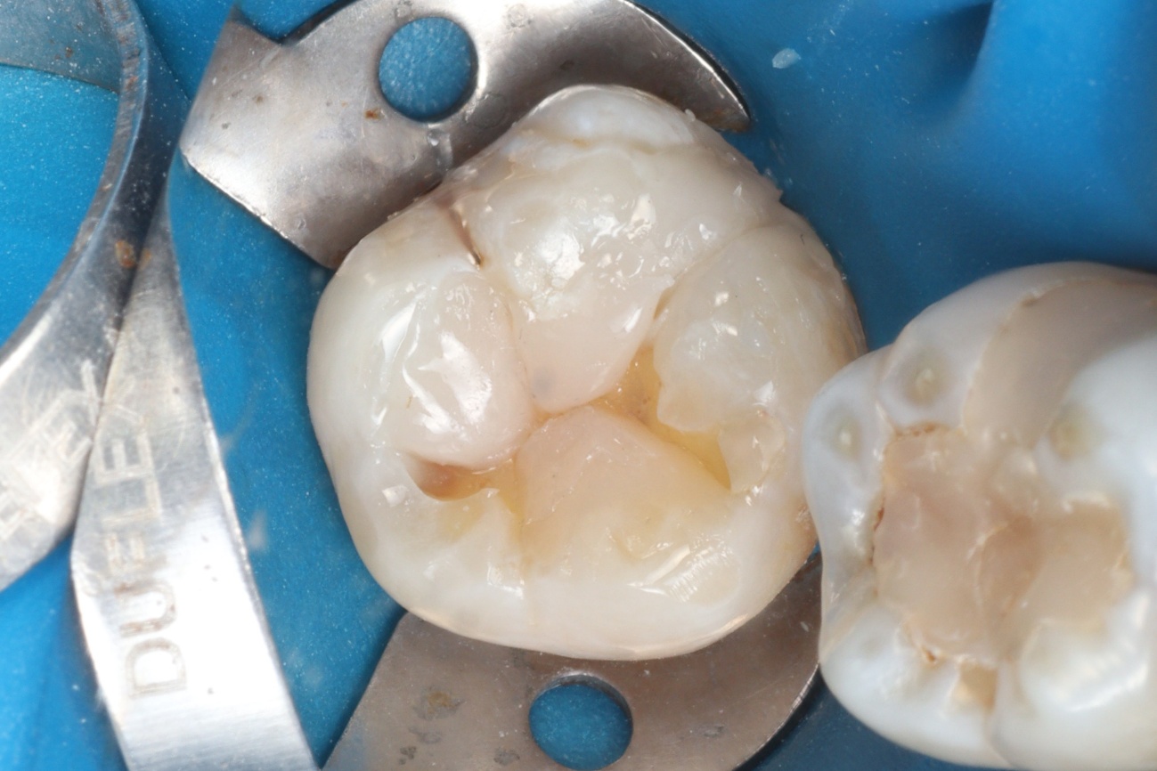 Figura 12 – parede cúspide V central, cúspide VD