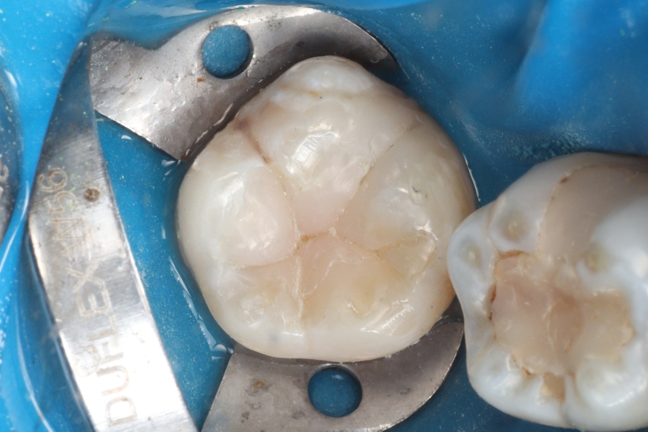 Figura 15 – acabamento e polimento inicial