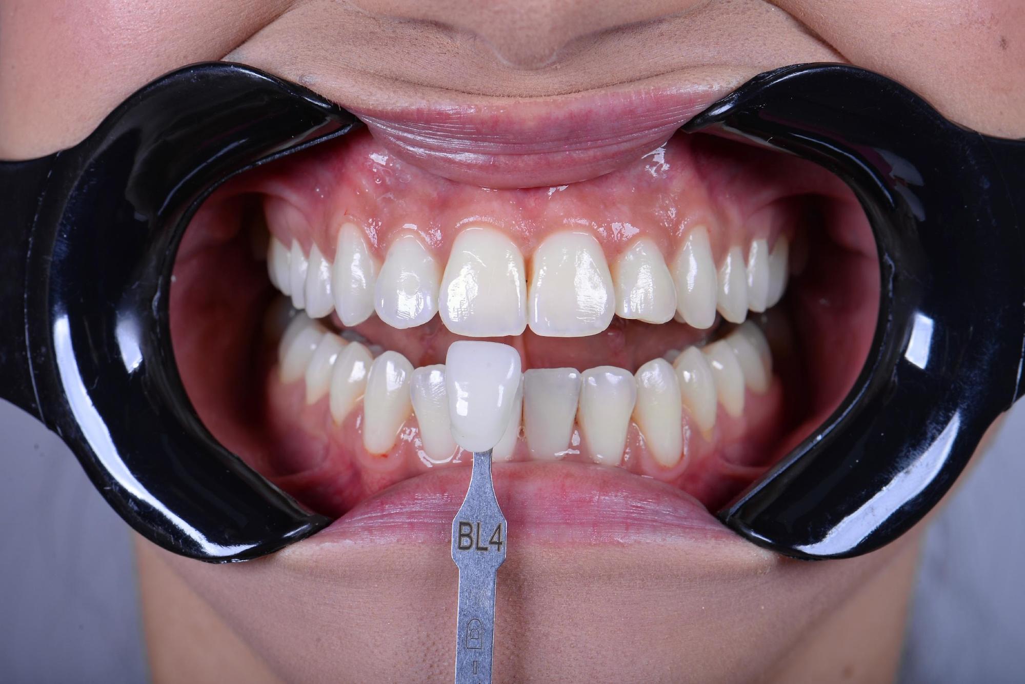Figura 1: Aspecto inicial do sorriso, evidenciando insatisfação estética pela coloração dentária na escala A1/BL4.