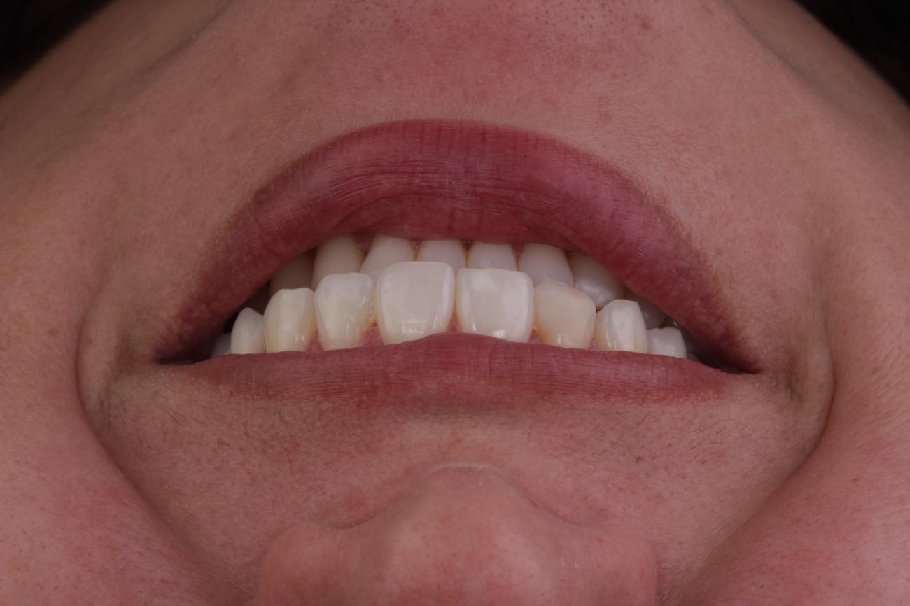 Figura 8 - Fotografia final após o clareamento