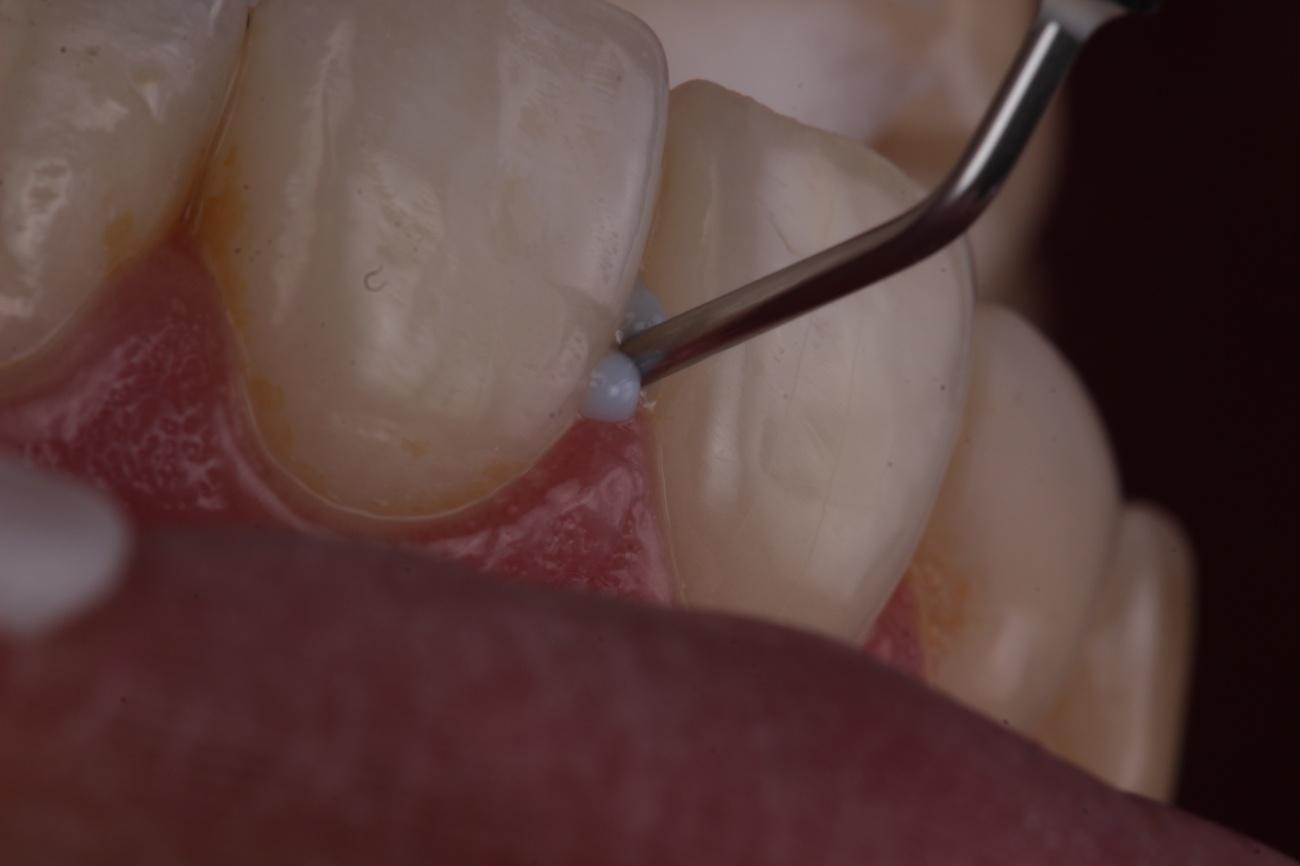 Figura 3 - Aplicação da barreira gengival