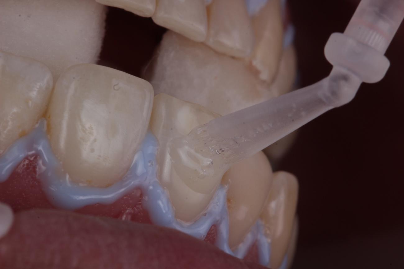 Figura 5 - Aplicação do gel clareador